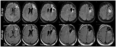 Characterization of Hand Clenching in Human Sensorimotor Cortex Using High-, and Ultra-High Frequency Band Modulations of Electrocorticogram